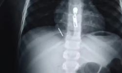 ابتلع مسماراً اخترق الرئة ووصل القلب.. فريق طبي ينقذ طفلاً في مصر